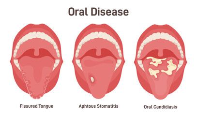Tongue problems set. Fissured tongue, oral candidiasis and aphthous