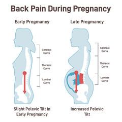 Back pain during pregnancy. Pregnant woman experiencing extreme - obrazy, fototapety, plakaty
