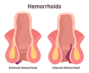 Two types of hemorrhoids. Internal and external hemorrhoidal