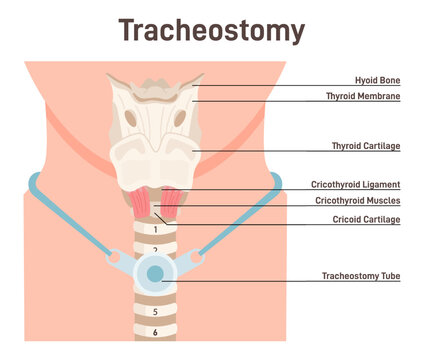 Tracheostomy. Tracheal Surgery Neutralise Airway Obstruction. Plastic Cannula