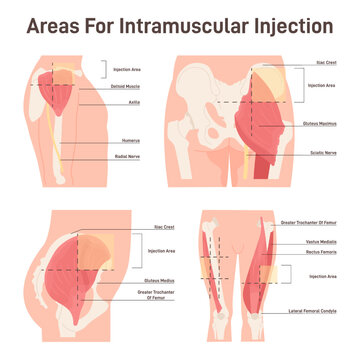 Intramuscular injection areas. Guide to injecting medication into muscle