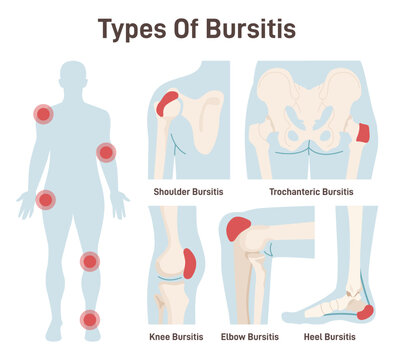 Types of bursitis set. Shoulder, hip, heel, knee and elbow joints inflammation.