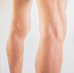 Leg and knee of an old man with muscle problems. bone and marrow