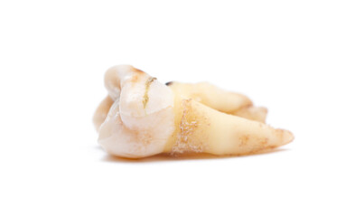 Close-up of a tooth with caries isolated on a white background. Removed wisdom teeth. Sick human teeth.