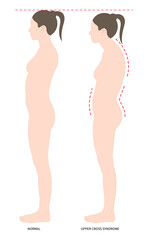 Fototapeta premium body poor and Postural anterior pelvic tilt upper cross syndrome trapezius of dowager’s painful spinal with Scheuermann's rounded Disk care