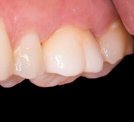 replacing old metal ceramic crown with new full ceramic crown
