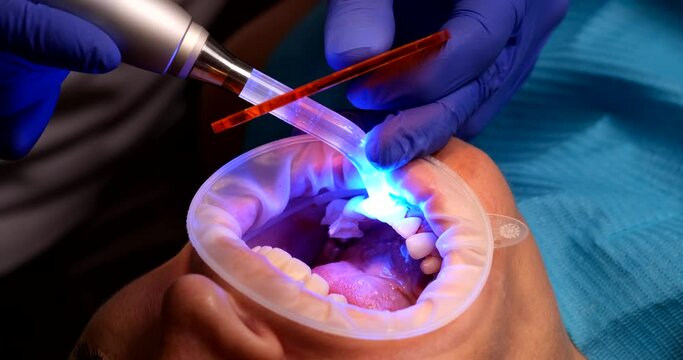 Closeup of female patient installing dental veneers and ultraviolet lamp at dentist in clinic