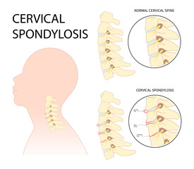 Tingling Numbness hand of spine degeneration thoracic neck root injury outlet pain damage canal syndrome Herniation traumatic bone disk spurs painful Spinal cord pinched nerves