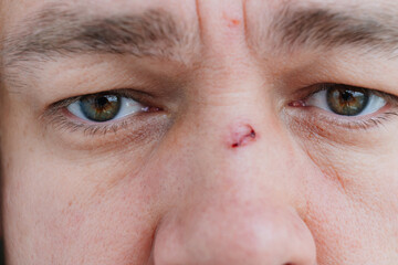 close-up. bloody abrasion on the bridge of the nose of a man after a blow. 