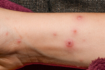 Chickenpox on the body of a child, Severe chicken pox crusts on rashes. papules and blisters.