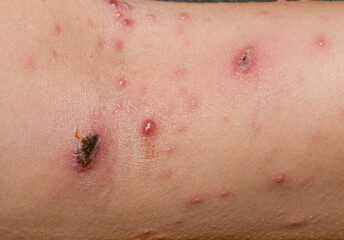 Chickenpox on the body of a child, Severe chicken pox crusts on rashes. papules and blisters.