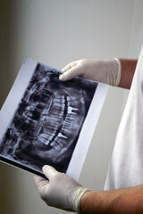 X-ray of the jaw in a scan for the diagnosis of implantation