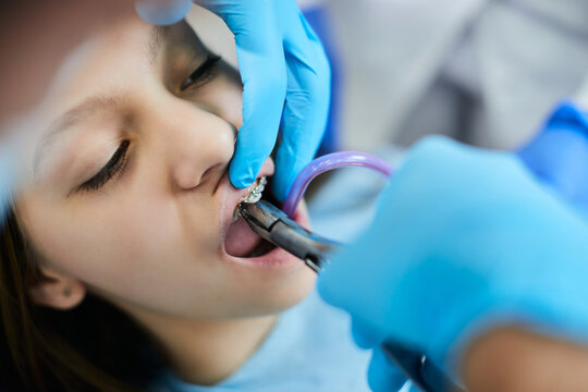 Close up of teenage girl getting her dental braces removed by orthodontist at dentist's office.