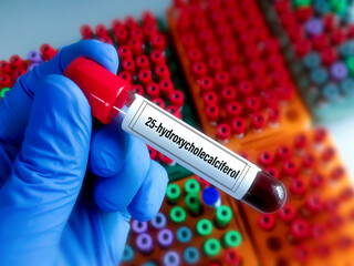 Obraz premium Blood sample for 25-hydroxycholecalciferol test, also known as 5-hydroxyvitamin D₃, calcifediol or calcidiol, is a form of vitamin D produced in the liver by hydroxylation of vitamin D₃
