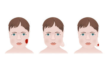 Types of hemangiomas on the face of a child. Medical poster vector illustration - obrazy, fototapety, plakaty