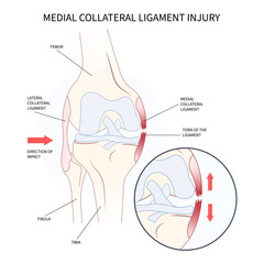 Medial collateral ligament Injury with athletic pop meniscal femur Grade or hurt test