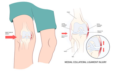 classification of Medial collateral ligament Injury test athletic meniscal femur pop hurt grade