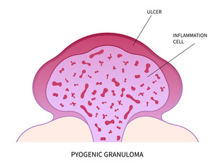 pyogenic granuloma skin tumor disease - obrazy, fototapety, plakaty