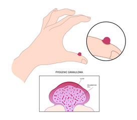 Hand and fingers with pyogenic granuloma skin tumor disease - obrazy, fototapety, plakaty
