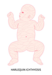 fetal with harlequin ichthyosis disorder