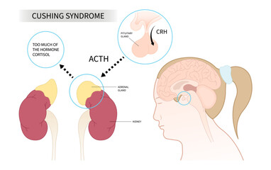 Cushing's or dowager's syndrome and Weight Gain fatty back neck obesity with hypertension high blood pressure