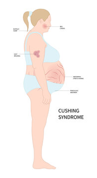 obesity syndrome with Cushing's or dowager's disease and Weight Gain fatty back neck hypertension high blood pressure