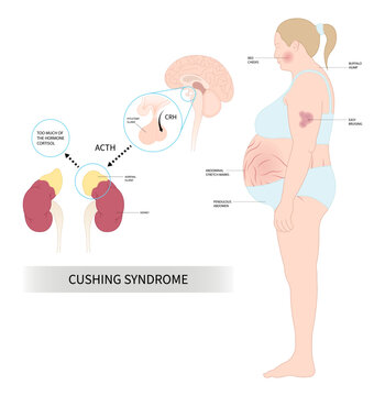 Cushing's or dowager's syndrome and Weight Gain fatty back neck obesity with hypertension high blood pressure