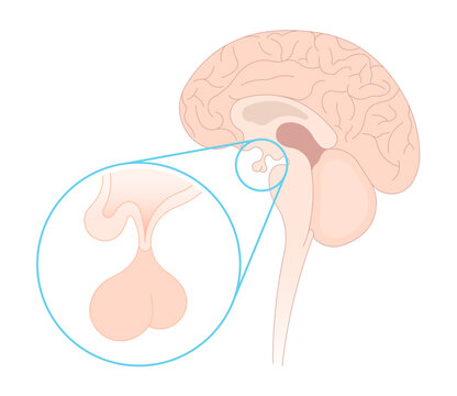 Brain of Cushing's or dowager's Weight Gain syndrome fatty back neck obesity hypertension high blood pressure