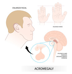 enlargement body of acromegaly giant with Insulin like Factor hormonal - obrazy, fototapety, plakaty
