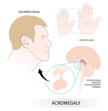 enlargement body of acromegaly giant with Insulin like Factor hormonal