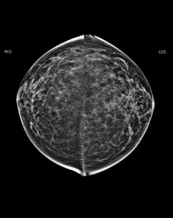  X-ray Digital Mammogram or mammography of both side breast Standard views are bilateral...