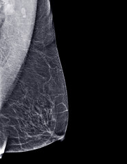 X-ray Digital Mammogram or mammography of both side breast Standard views are  mediolateral oblique (MLO) views .