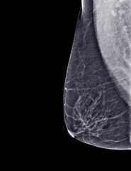 X-ray Digital Mammogram or mammography of both side breast Standard views are  mediolateral oblique (MLO) views .