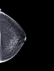  X-ray Digital Mammogram or mammography of both side breast Standard views are bilateral craniocaudal (CC) .