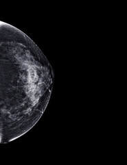  X-ray Digital Mammogram or mammography of both side breast Standard views are bilateral...