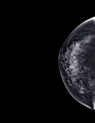  X-ray Digital Mammogram or mammography of both side breast Standard views are bilateral craniocaudal (CC) .