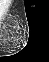 X-ray Digital Mammogram or mammography of both side breast Standard views are  mediolateral oblique...
