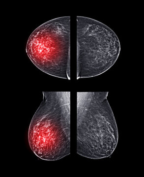  X-ray Digital Mammogram or mammography of both side breast CC view and MLO  .