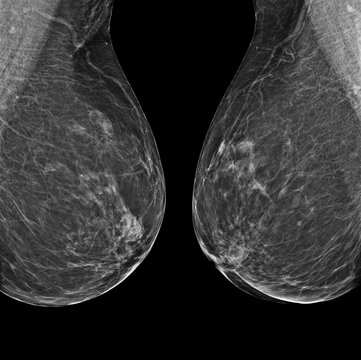 X-ray Digital Mammogram or mammography of both side breast Standard views are  mediolateral oblique (MLO) views .
