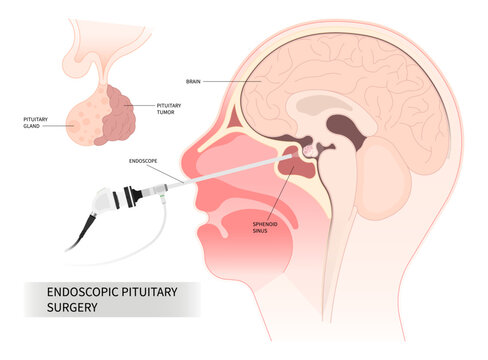 endoscopic pituitary surgery for cushing disease disorder Growth of adrenocorticotropin adrenal cortisol Transcranial Oxytocin Follicle stimulating Microadenomas and Macroadenomas anatomy