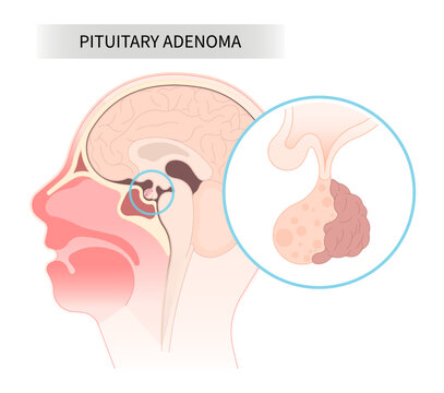 anatomy of pituitary disease surgery for cushing disorder Growth of adrenocorticotropin adrenal cortisol Transcranial Oxytocin Follicle endoscopic stimulating with Microadenomas and Macroadenomas