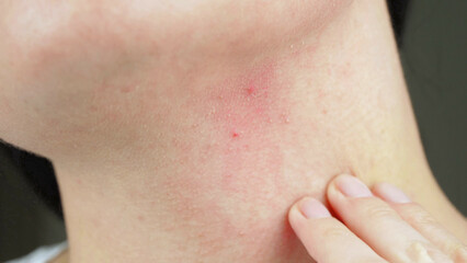 A close-up hand touches a red inflamed acne. Allergic reaction, dermatitis. Cosmetology.