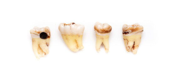 Set of teeth with caries on a white background. Wisdom teeth removed. Sick human teeth.