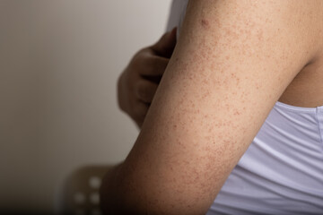 keratosis, pilaris, disease, background, woman, texture, hair, white, health, medical, medicine,...