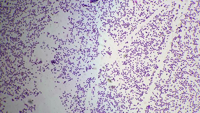 Smear of human blood under microscope with 100 times magnification on bright field. Erythrocytes and monocytes educated in medical lab. Studying hematology for helping people health. Immune system