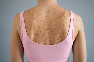 Woman Body Skin With Red Allergy Eruption