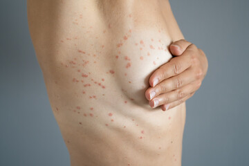 Woman Body Skin With Red Allergy Eruption