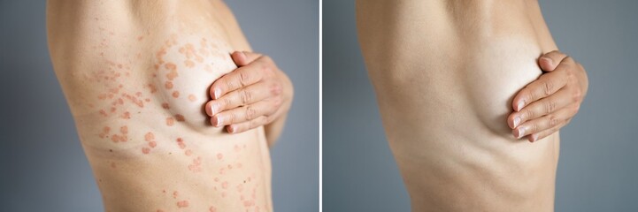 Psoriasis Disease Treatment Before After - obrazy, fototapety, plakaty