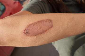 Cut wound on arm and a chemical burn from hydrogen peroxide. Close up of a healing injury of skin.