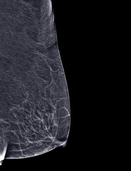 X-ray Digital Mammogram or mammography of both side breast Standard views are  mediolateral oblique (MLO) views .